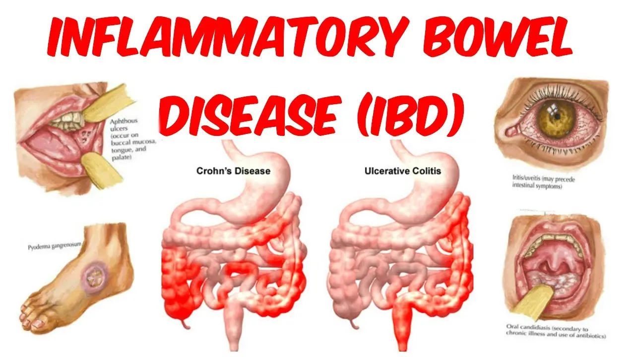 The five worst bowel diseases