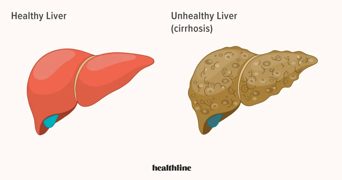 The five worst liver diseases