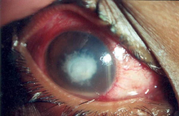 The four most common eye infections that cannot be underestimated