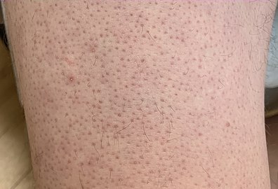 The keratosis gene