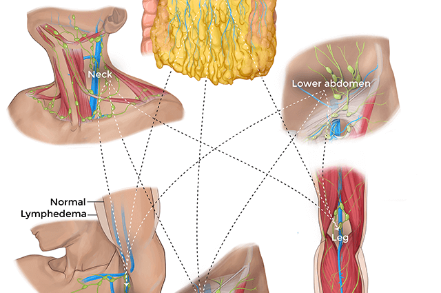 The Lymphoedema Treatment Department was established in Ustroń