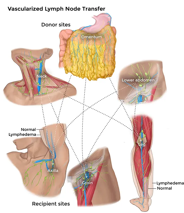 The Lymphoedema Treatment Department was established in Ustroń