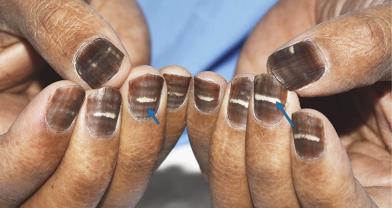 The man&#8217;s nails suddenly turned brown. An unusual medical case