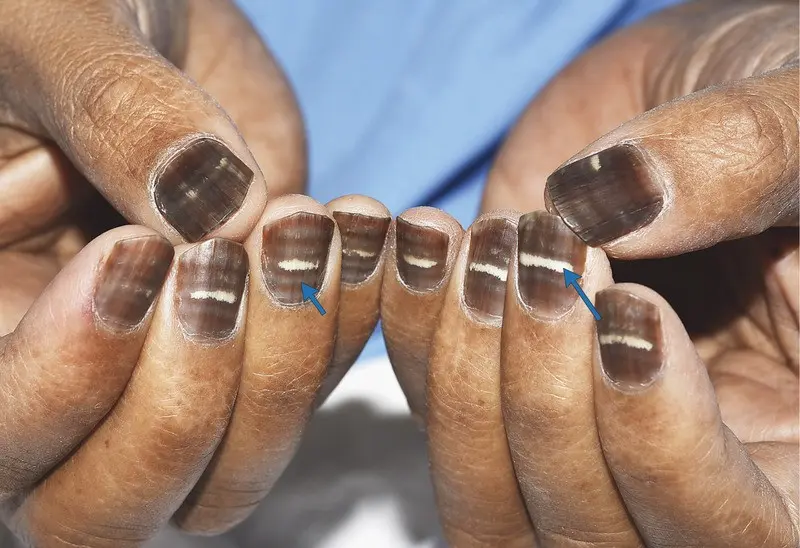 The man&#8217;s nails suddenly turned brown. An unusual medical case