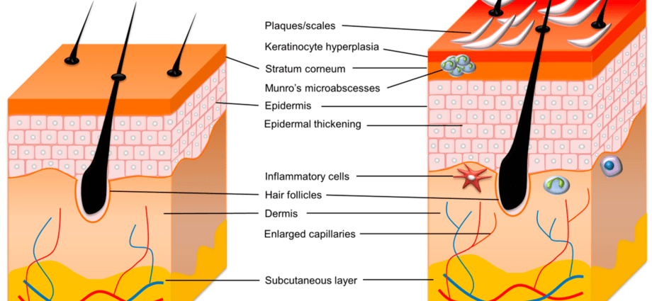 The Ministry of Health does not introduce modern therapy for children with severe plaque psoriasis