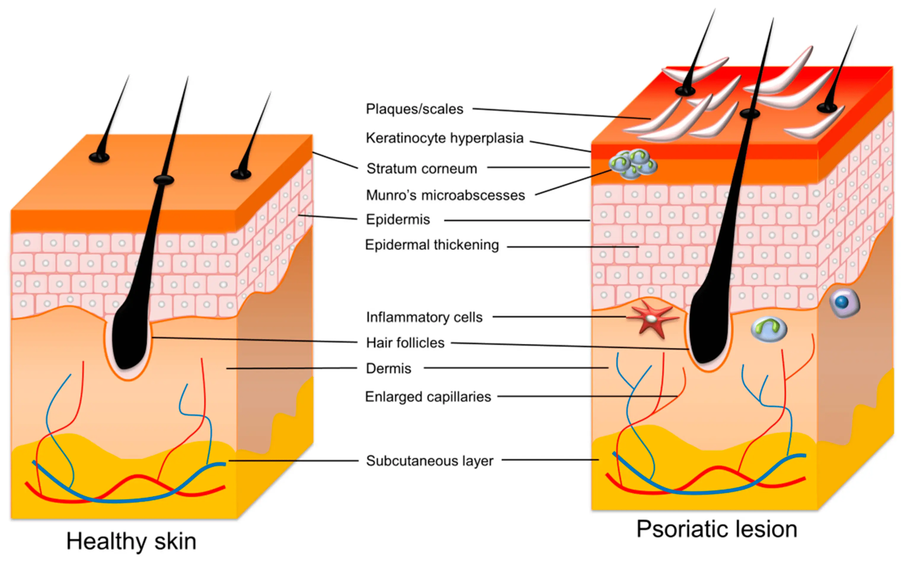 The Ministry of Health does not introduce modern therapy for children with severe plaque psoriasis