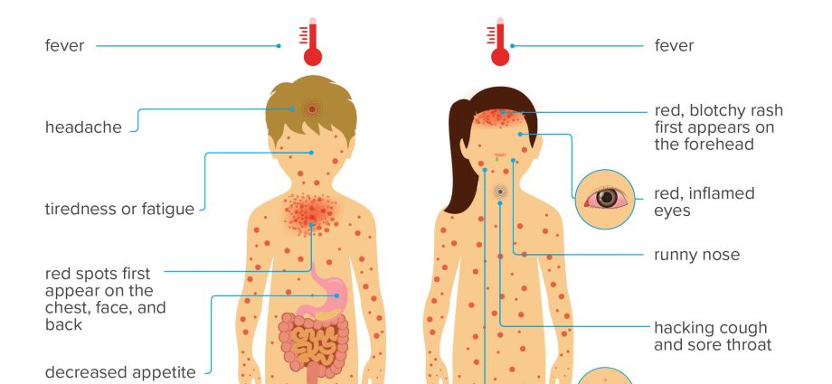 The most common diseases of young children &#8211; intestine, smallpox, tonsillitis