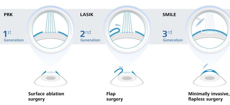 The most modern methods of vision correction. Why is it worth choosing?