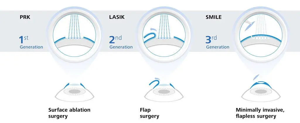 The most modern methods of vision correction. Why is it worth choosing?