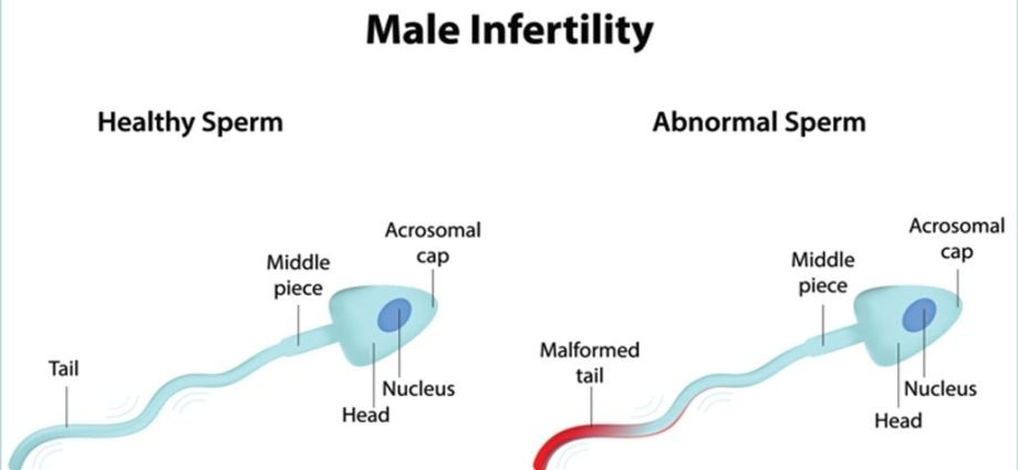 The MSOME-6600 study in the diagnosis of male infertility &#8211; preparation, course, indications, price