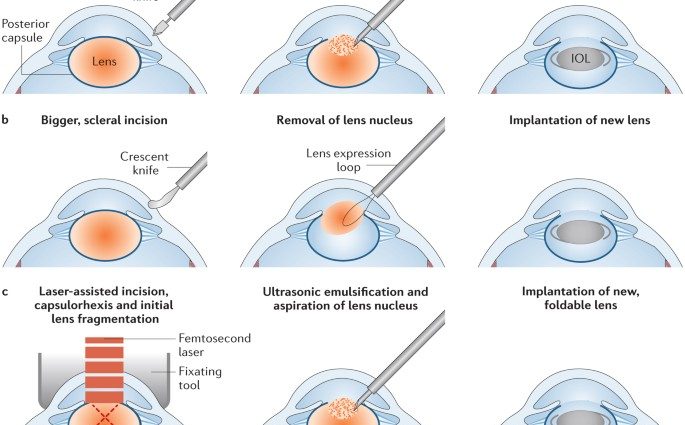 The National Health Fund refunds the treatment of astigmatism and cataracts &#8211; one procedure is enough