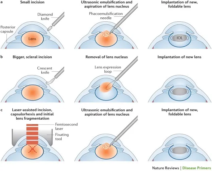 The National Health Fund refunds the treatment of astigmatism and cataracts &#8211; one procedure is enough