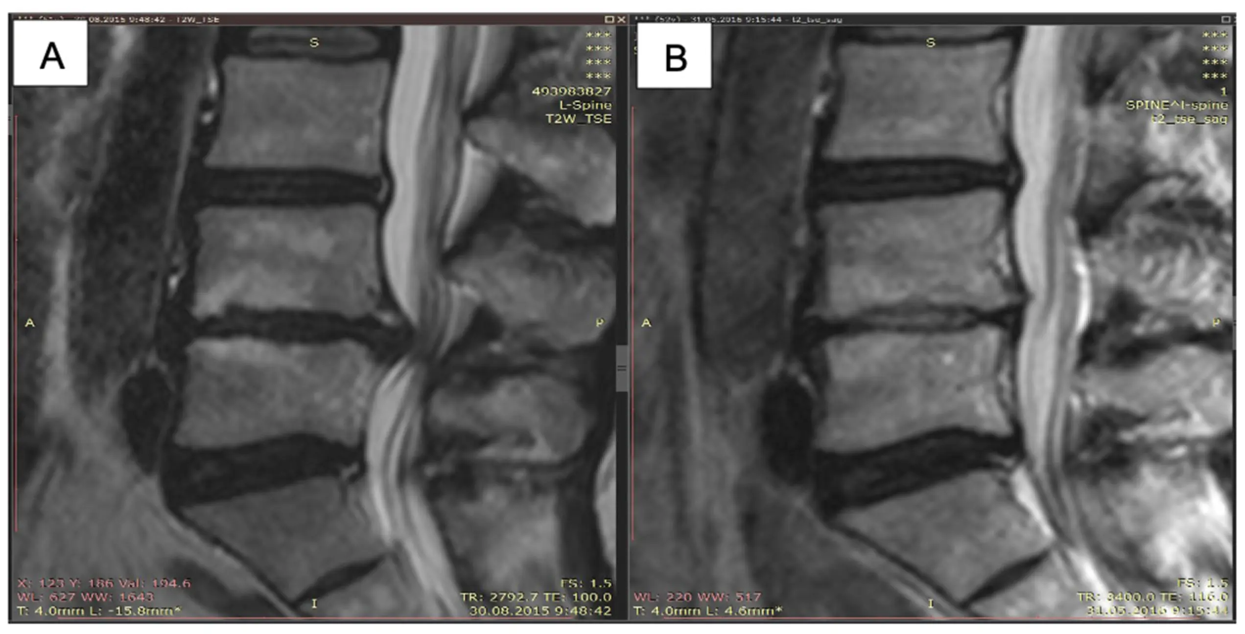 The nine-year-old&#8217;s brain &#8220;slipped&#8221; into the spinal canal. A series of treatments was performed