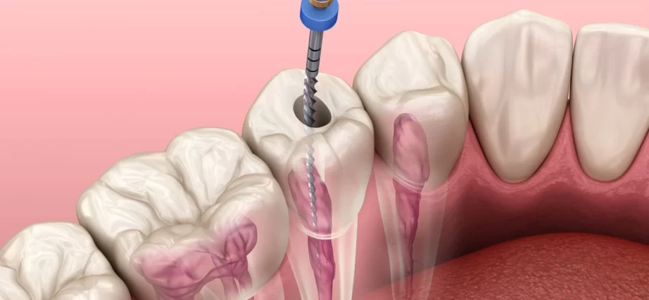 The price of root canal treatment &#8211; what does the amount of costs depend on?