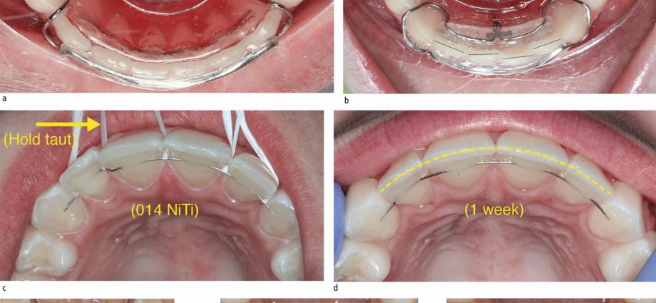 The retention apparatus and its role in the orthodontic treatment of dentition