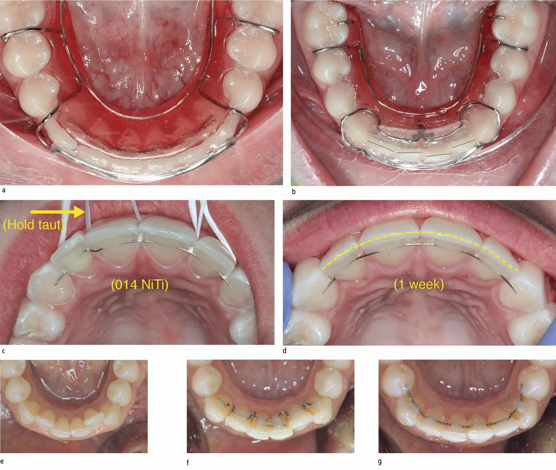 The retention apparatus and its role in the orthodontic treatment of dentition