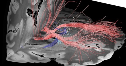 The stimulator will cure the obsessive compulsive disorder. A breakthrough treatment by doctors from Wrocław