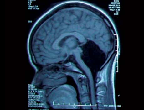 The study revealed that the 24-year-old did not have a cerebellum