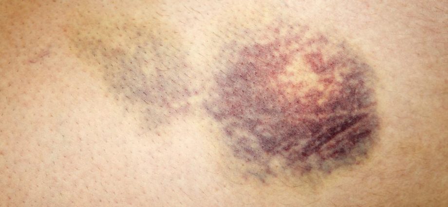 The symptom may be bruising and frequent infections. If left untreated, it quickly leads to death