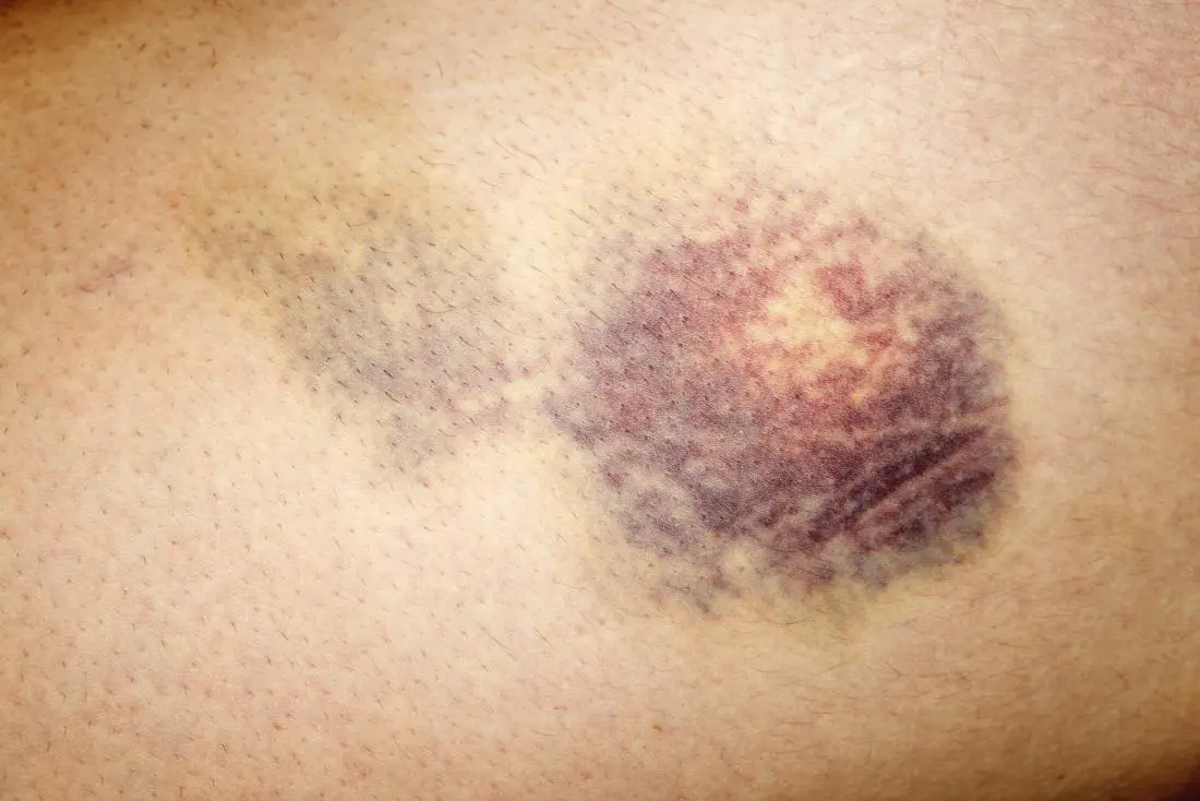 The symptom may be bruising and frequent infections. If left untreated, it quickly leads to death