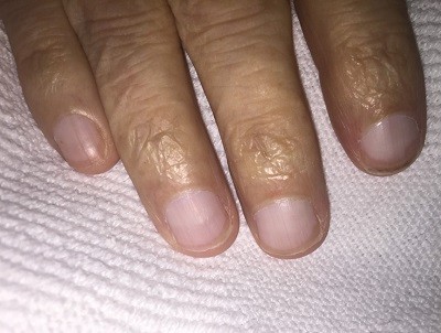 The symptom of cirrhosis of the liver appears on the nails