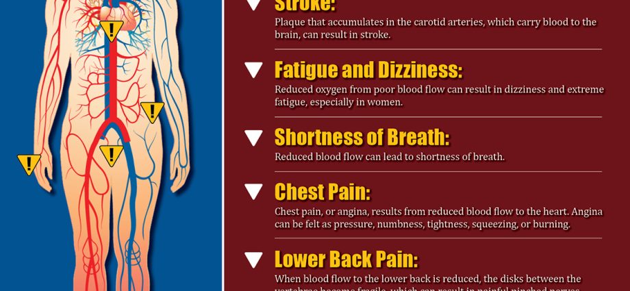 The symptoms of atherosclerosis are hidden for many years. Here are the warning signs of clogged arteries