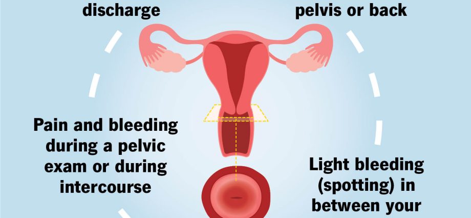 The term &#8220;erosion&#8221; is worrying. The gynecologist explains the risks