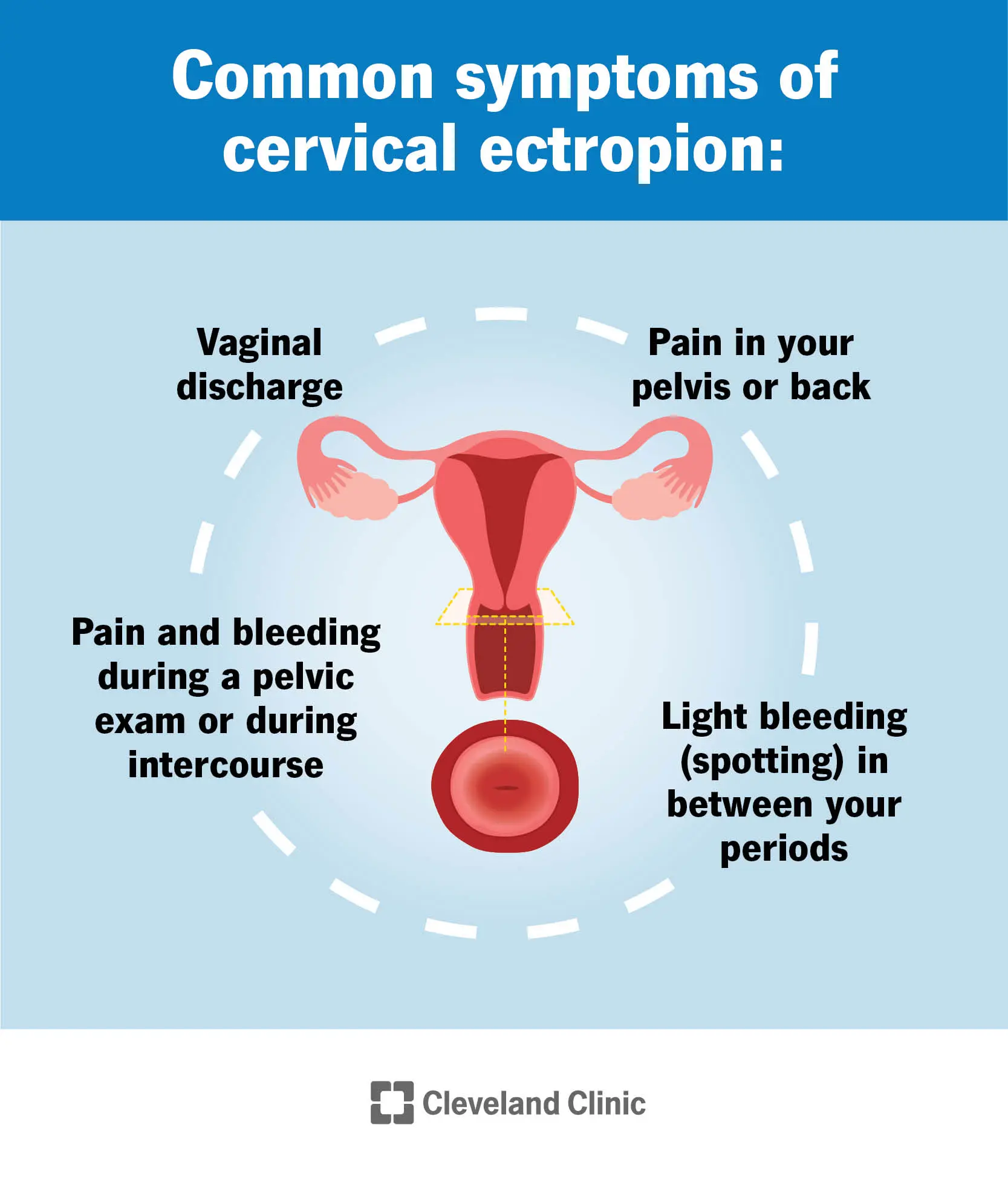 The term &#8220;erosion&#8221; is worrying. The gynecologist explains the risks