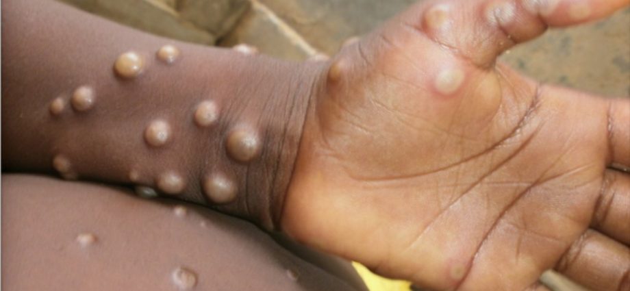 The threat of monkey pox is growing. WHO is calling a crisis meeting