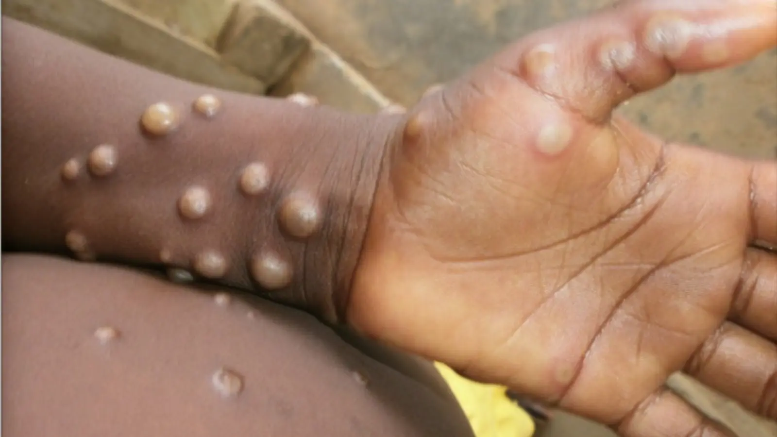 The threat of monkey pox is growing. WHO is calling a crisis meeting