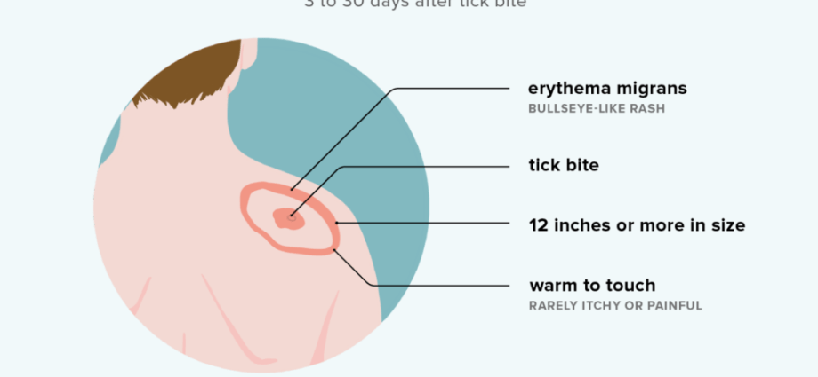 The three earliest symptoms of Lyme disease. See if you could catch it