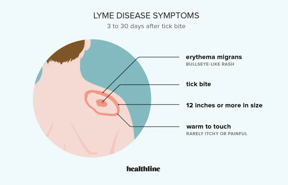 The three earliest symptoms of Lyme disease. See if you could catch it