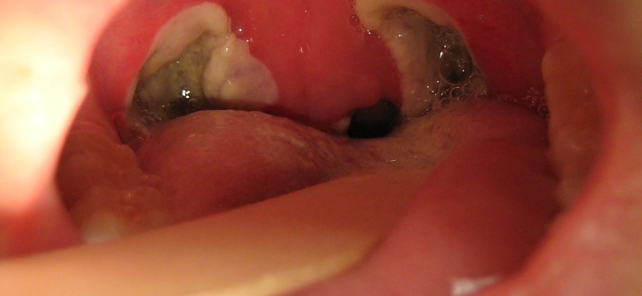 The tragic end of tonsillectomy