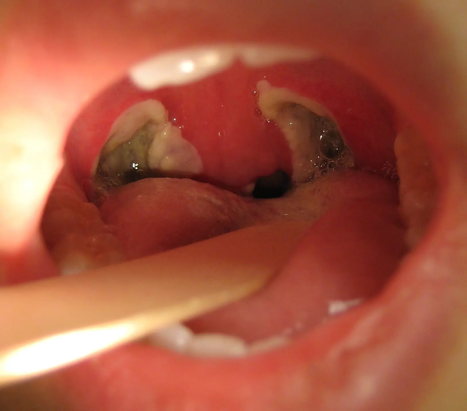 The tragic end of tonsillectomy