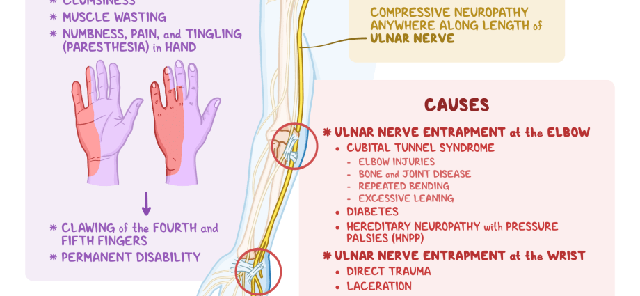 The ulnar nerve &#8211; ailments, symptoms of the disease, treatment of disorders