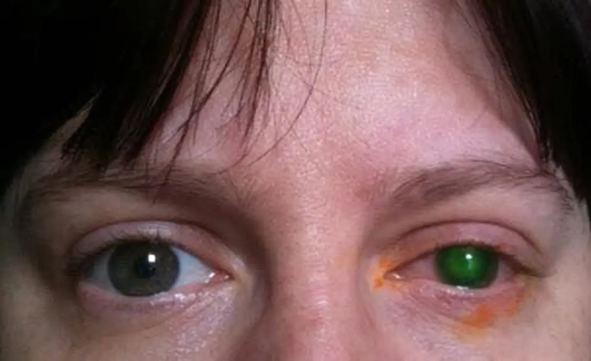 The young woman almost lost her sight from swimming in contact lenses. A corneal transplant was necessary