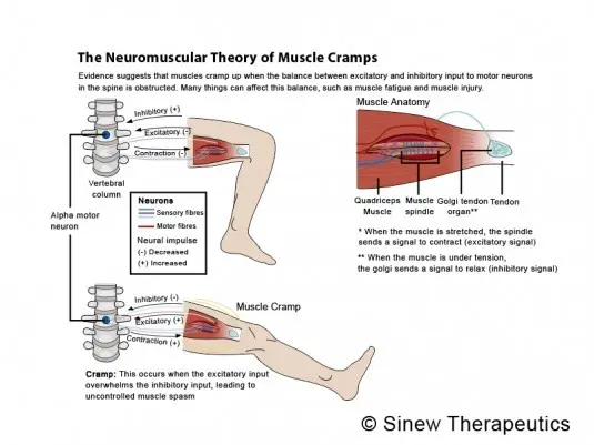 Thermal muscle cramps &#8211; what is it, the mechanism of its formation, causes, symptoms