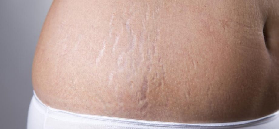 These unusual symptoms may indicate cancer. Stretch marks on the list