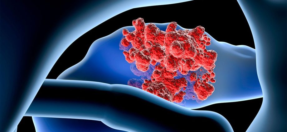 They can be a signal of pancreatic cancer. New findings of scientists