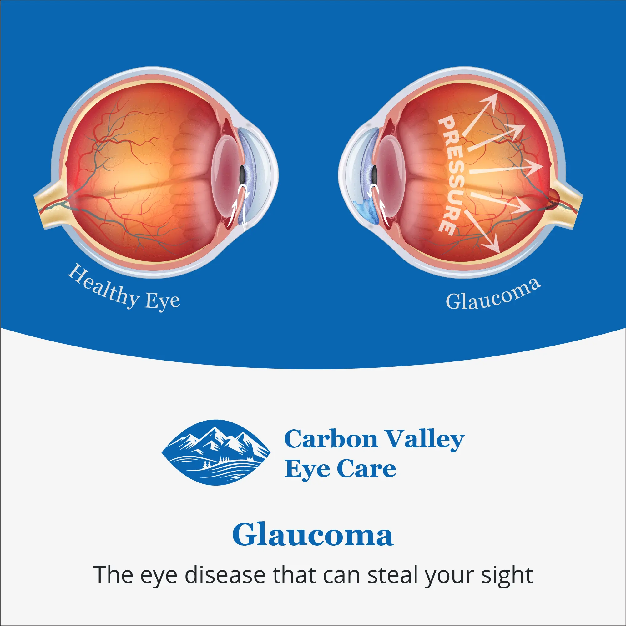 This disease does not hurt, it only steals your eyesight. Examine your eyes and escape the glaucoma!