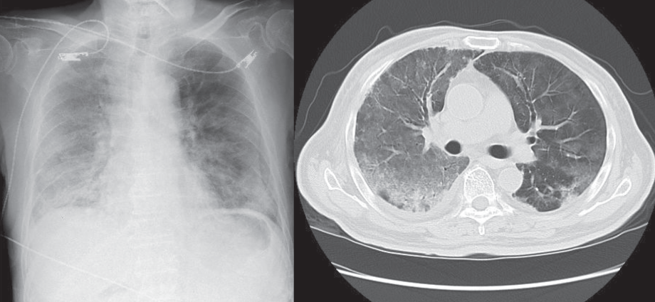 This drug may protect against lung damage after COVID-19. It has been used for 70 years