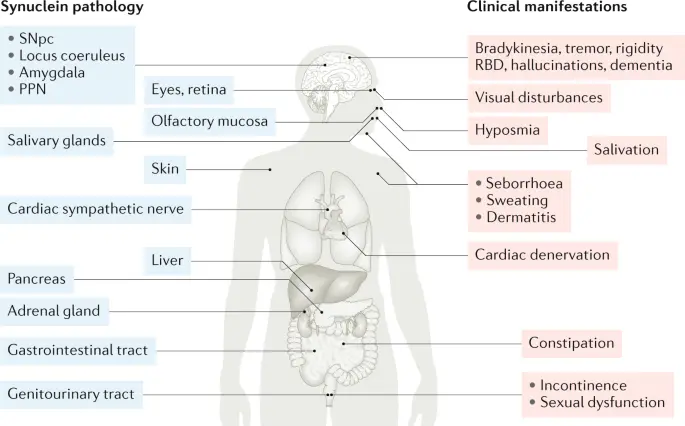 This is how you delay the symptoms of Parkinson&#8217;s disease. Experts have no doubts