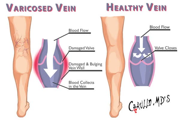 This is how you &#8220;work&#8221; for varicose veins