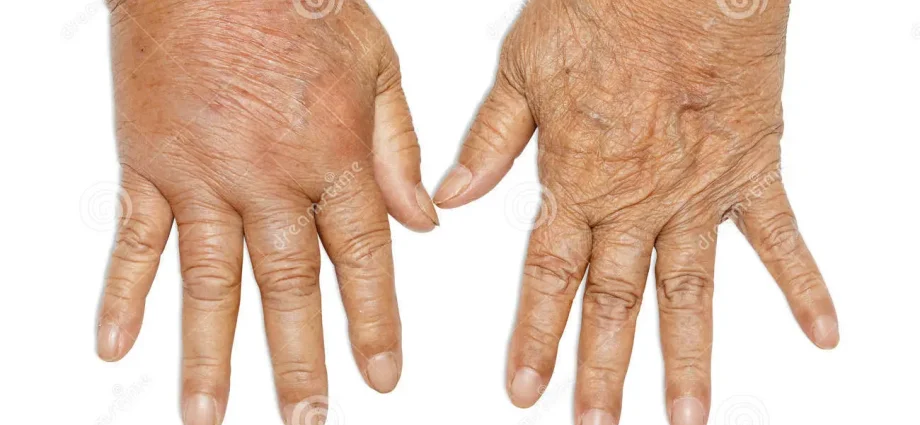 This is what the diabetic&#8217;s hand looks like [PHOTO]