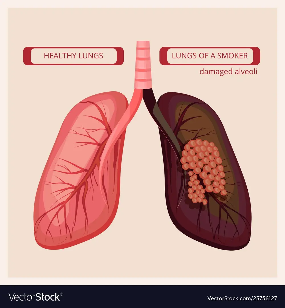 This is what the lungs of a smoker with cancer look like, and so healthy. Scary? Understatement