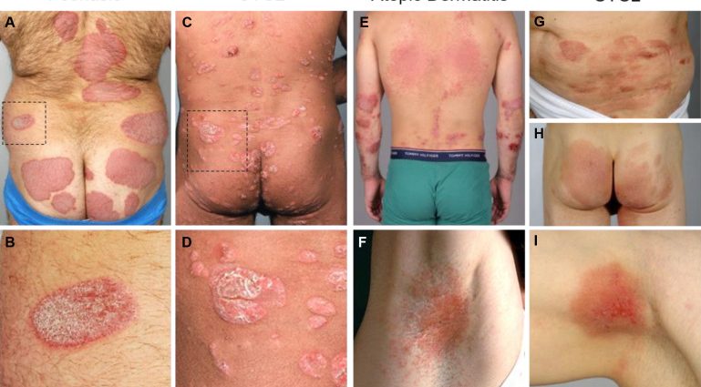 This lymphoma is confused with allergies, psoriasis, and atopic dermatitis. Early, correct diagnosis is a chance for a better life