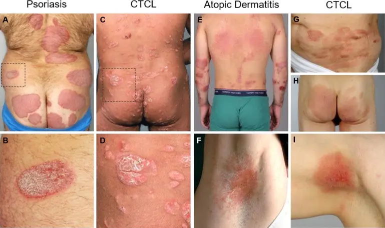 This lymphoma is confused with allergies, psoriasis, and atopic dermatitis. Early, correct diagnosis is a chance for a better life