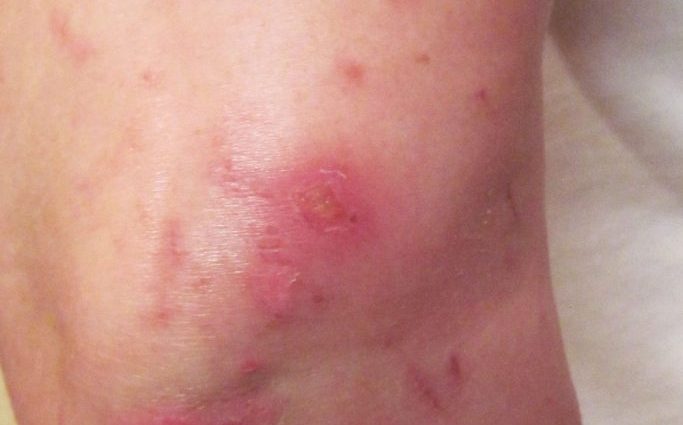 This popular garden plant can get severe burns. Wounds heal for months [PHOTOS]