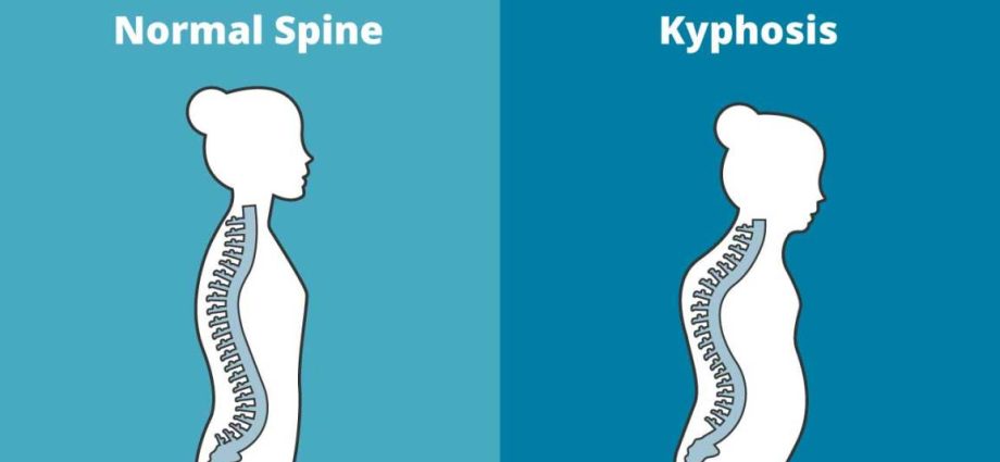 Thoracic kyphosis &#8211; causes of deepening, treatment