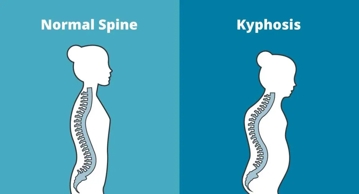 Thoracic kyphosis &#8211; causes of deepening, treatment